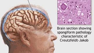 At Least 5 Million Americans Now Have Alzheimer's