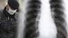 Ukraine Black Lungs: Fears unknown flu-strain to spread (Video)