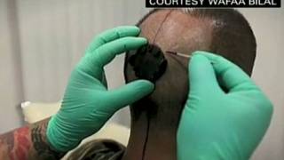 Man Has Camera Implanted In His Head