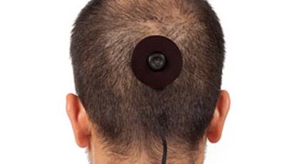 Pain Leads Art Professor to Remove "Third Eye" Camera From Head