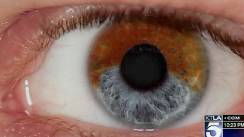 Laser procedure turns brown eyes blue, scientist says