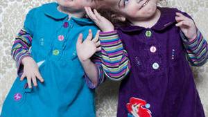 Do these conjoined twins share consciousness?