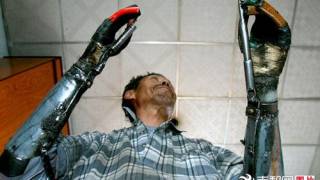 Man Builds Himself Bionic Hands After Losing Both of His