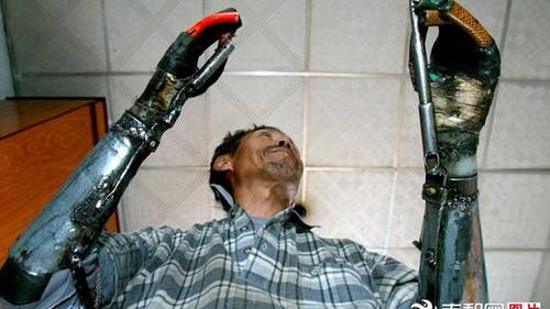 Man Builds Himself Bionic Hands After Losing Both of His