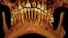 Mummy with Mouthful of Cavities Discovered