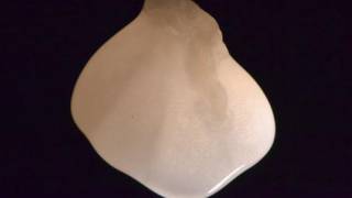 Lab-made kidneys raise hopes for dialysis patients