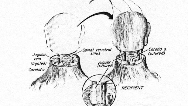 Neuroscientist claims head transplants now a realistic procedure