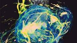 Sugar makes cancer light-up in MRI scanners