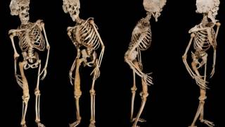 Unlocking the secrets of the Elephant Man