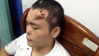 Doctors Grow Nose on Man’s Forehead