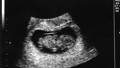 Infertile woman gives birth after ’boost’ to ovaries