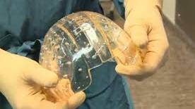 The first transparent 3D-printed skull has been successfully implanted