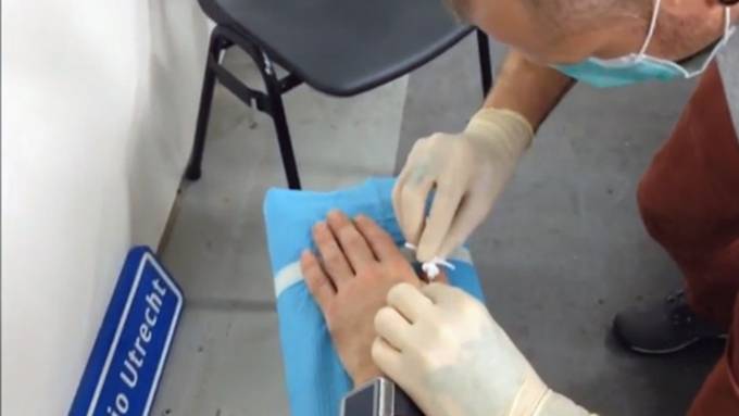 Man embeds computer chips in hands to store Bitcoin