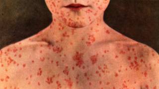 The Vaccinated Spreading Measles: WHO, Merck, CDC Documents Confirm