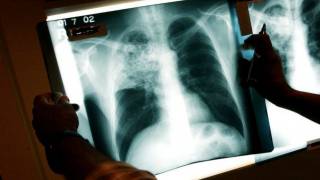 1,565 Refugees Diagnosed with Active TB Since 2012, Three Times More Than Previously Reported