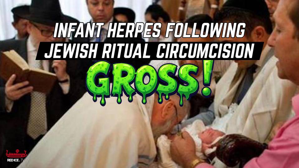 Another Infant Contracts Herpes After Rabbi Sucks Baby's Pen*s Following Jewish Ritual Circumcision