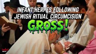 Another Infant Contracts Herpes After Rabbi Sucks Baby's Pen*s Following Jewish Ritual Circumcision